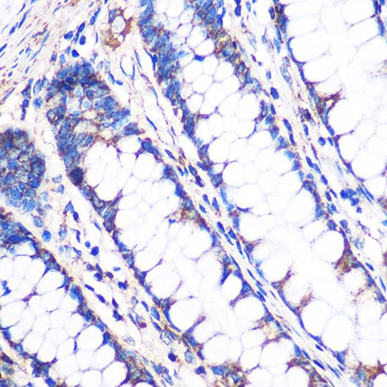 Immunohistochemistry of paraffin-embedded Human colon using NDUFA4L2 Rabbit pAb  at dilution of 1:100 