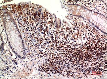 Immunohistochemical analysis of paraffin-embedded Human Colon Carcinoma Tissue using Epsilon Tubulin Mouse mAb diluted at 1:200