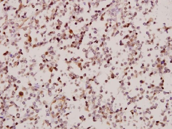 Immunohistochemistry (IHC) analyzes of ARMCX2 (D347) pAb in paraffin-embedded human tonsil carcinoma tissue at 1:50