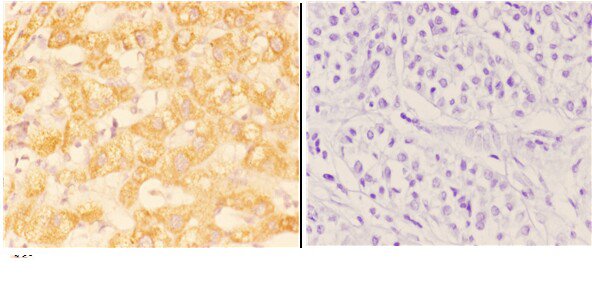 Immunohistochemistry (IHC) analyzes of ABHD13 pAb in paraffin-embedded human liver carcinoma tissue at 1:50,showing cytoplasmic and membrane staining
