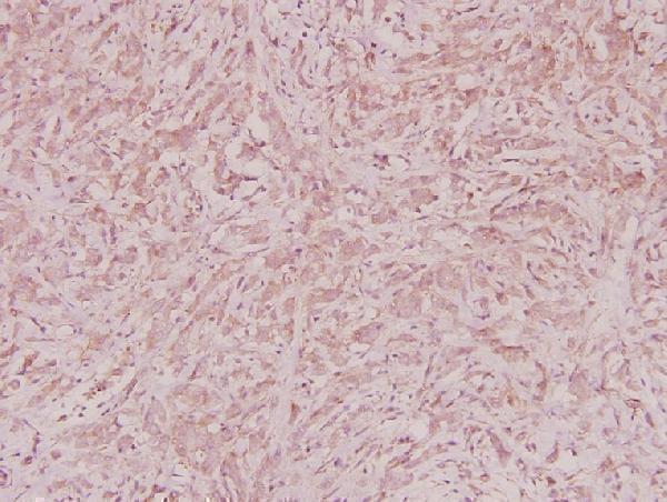 Immunohistochemistry (IHC) analyzes of ZNF134 (K72) pAb in paraffin-embedded human breast carcinoma tissue at 1:100
