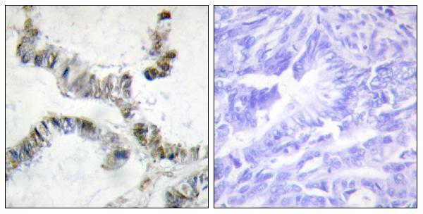 Immunohistochemistry analysis of paraffin-embedded human colon carcinoma, using SMF Antibody
