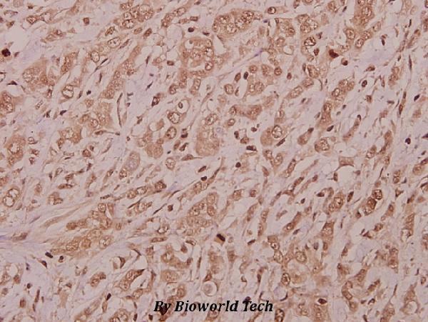 Immunohistochemistry (IHC) analyzes of CSRNP2 (K127) pAb in paraffin-embedded human colorectal carcinoma tissue at 1:50