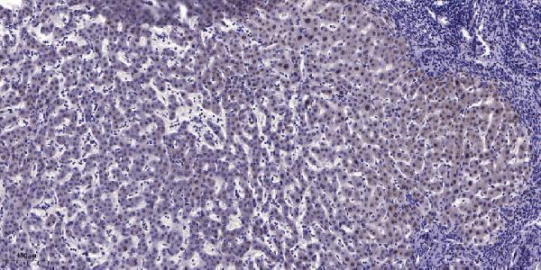 Immunohistochemical analysis of paraffin-embedded human liver cancer