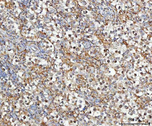 Figure 5. IHC analysis of MOSPD2 using anti-MOSPD2 antibody (A16695-1). MOSPD2 was detected in a paraffin-embedded section of human testicular germ cell tumors tissue. Heat mediated antigen retrieval was performed in EDTA buffer (pH 8.0, epitope retrieval solution). The tissue section was blocked with 10% goat serum. The tissue section was then incubated with 2 microg/ml rabbit anti-MOSPD2 Antibody (A16695-1) overnight at 4°C. Peroxidase Conjugated Goat Anti-rabbit IgG was used as secondary antibody and incubated for 30 minutes at 37°C. The tissue section was developed using HRP Conjugated Rabbit IgG Super Vision Assay Kit (Catalog # SV0002) with DAB as the chromogen. Figure 5. IHC analysis of MOSPD2 using anti-MOSPD2 antibody (A16695-1). MOSPD2 was detected in a paraffin-embedded section of human testicular germ cell tumors tissue. Heat mediated antigen retrieval was performed in EDTA buffer (pH 8.0, epitope retrieval solution). The tissue section was blocked with 10% goat serum. The tissue section was then incubated with 2 microg/ml rabbit anti-MOSPD2 Antibody (A16695-1) overnight at 4°C. Peroxidase Conjugated Goat Anti-rabbit IgG was used as secondary antibody and incubated for 30 minutes at 37°C. The tissue section was developed using HRP Conjugated Rabbit IgG Super Vision Assay Kit (Catalog # SV0002) with DAB as the chromogen.