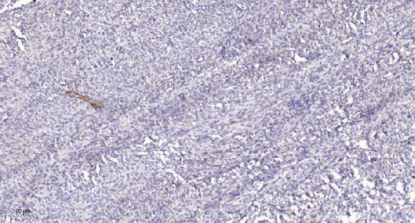 Immunohistochemical analysis of paraffin-embedded human Colon cancer