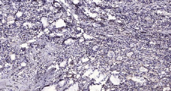 Immunohistochemical analysis of paraffin-embedded human Gastric adenocarcinoma