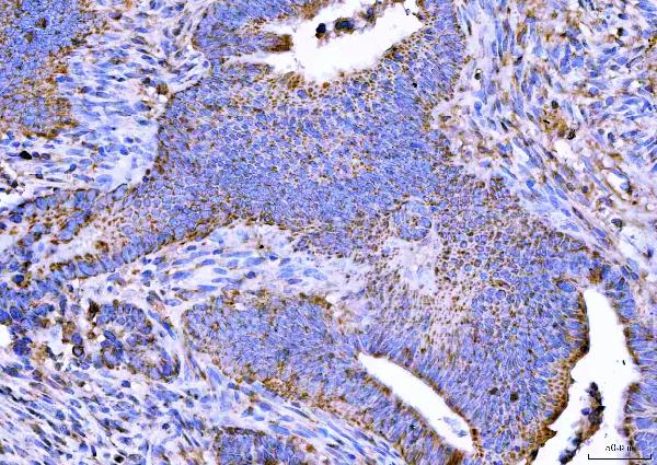 Figure 2. IHC analysis of NTN3 using anti-NTN3 antibody (A17692). NTN3 was detected in a paraffin-embedded section of human colorectal adenocarcinoma tissue. Heat mediated antigen retrieval was performed in EDTA buffer (pH 8.0, epitope retrieval solution). The tissue section was blocked with 10% goat serum. The tissue section was then incubated with 2 microg/ml rabbit anti-NTN3 Antibody (A17692) overnight at 4°C. Peroxidase Conjugated Goat Anti-rabbit IgG was used as secondary antibody and incubated for 30 minutes at 37°C. The tissue section was developed using HRP Conjugated Rabbit IgG Super Vision Assay Kit (Catalog # SV0002) with DAB as the chromogen.