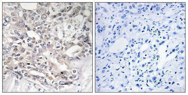 Immunohistochemistry analysis of paraffin-embedded human liver carcinoma tissue, using APOL5 Antibody