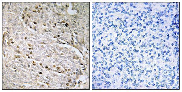 Immunohistochemistry analysis of paraffin-embedded human prostate carcinoma, using POTE8 Antibody