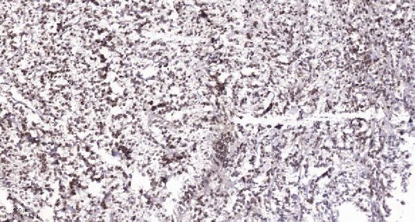 Immunohistochemical analysis of paraffin-embedded human Colon cancer