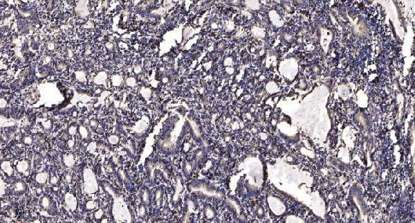 Immunohistochemical analysis of paraffin-embedded human Gastric adenocarcinoma