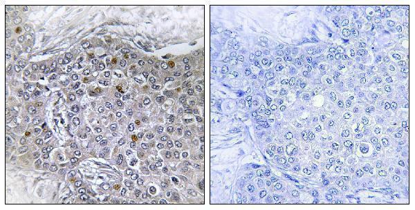 Immunohistochemistry analysis of paraffin-embedded human breast carcinoma tissue, using ZMY11 Antibody