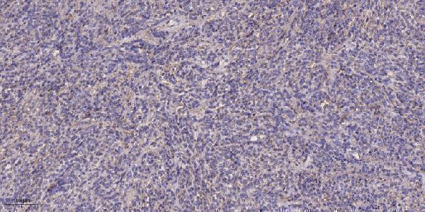 Immunohistochemical analysis of paraffin-embedded human Colon cancer