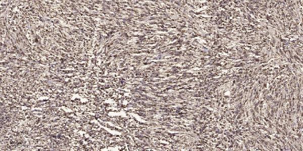 Immunohistochemical analysis of paraffin-embedded human small intestinal carcinoma tissue