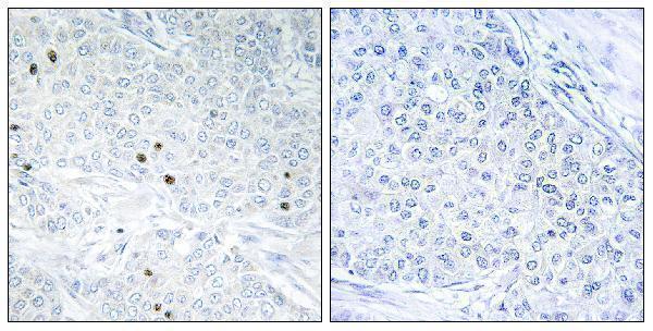 Immunohistochemistry analysis of paraffin-embedded human breast carcinoma tissue, using TP53INP2 Antibody