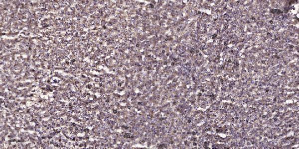 Immunohistochemical analysis of paraffin-embedded human liver cancer
