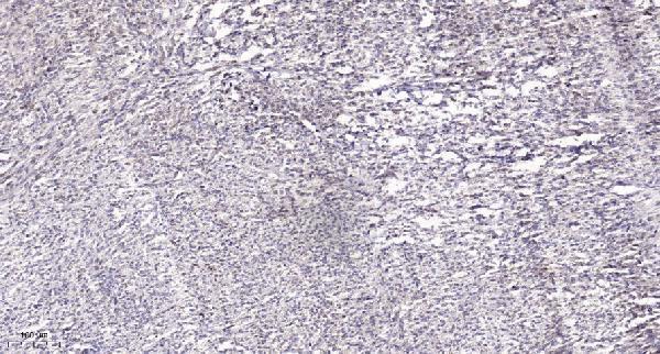 Immunohistochemical analysis of paraffin-embedded human Small intestinal stromal tumor
