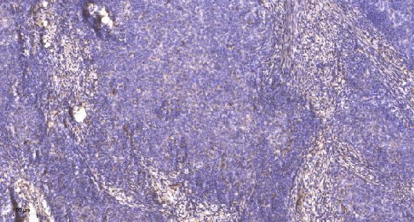 Immunohistochemical analysis of paraffin-embedded human cervical carcinoma