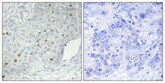 Immunohistochemical analysis of paraffin-embedded Human breast cancer