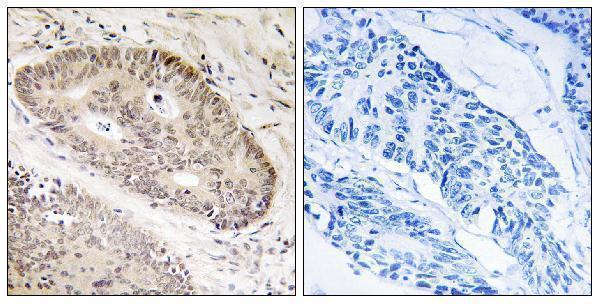 Immunohistochemistry analysis of paraffin-embedded human lung carcinoma tissue, using ALS2CR8 Antibody