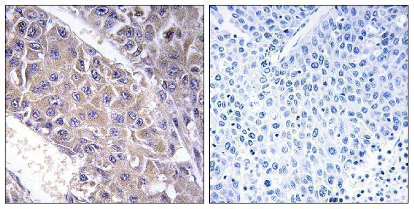 Immunohistochemistry analysis of paraffin-embedded human liver carcinoma tissue, using B4GALT3 Antibody