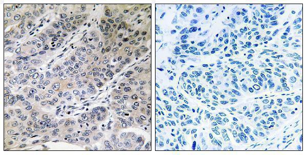 Immunohistochemistry analysis of paraffin-embedded human lung carcinoma tissue, using BRP44 Antibody