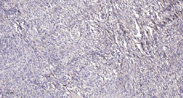 Immunohistochemical analysis of paraffin-embedded human Colon cancer