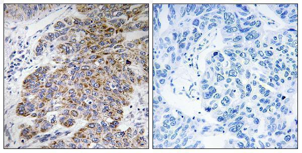 Immunohistochemistry analysis of paraffin-embedded human lung carcinoma tissue, using CHST10 Antibody