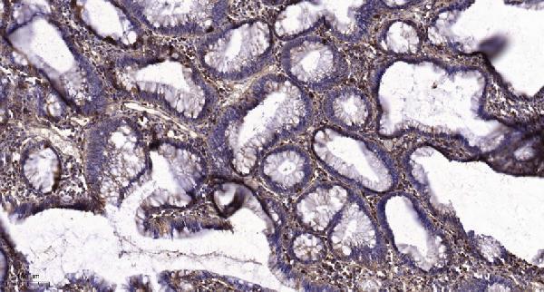 Immunohistochemical analysis of paraffin-embedded human colon cancer
