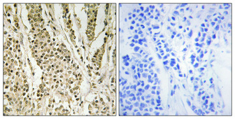 Immunohistochemical analysis of paraffin-embedded Human breast cancer
