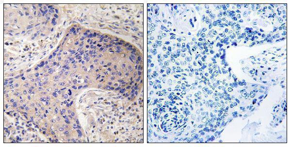 Immunohistochemistry analysis of paraffin-embedded human prostate carcinoma tissue, using ST6GAL1 Antibody