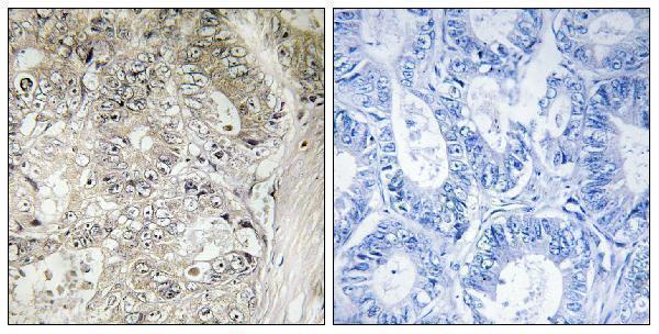 Immunohistochemistry analysis of paraffin-embedded human colon carcinoma tissue, using CST1 Antibody