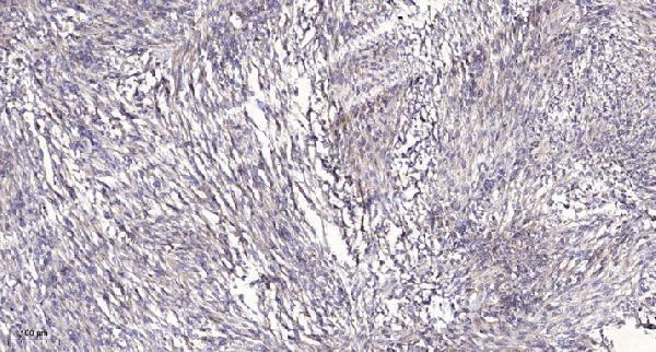 Immunohistochemical analysis of paraffin-embedded human Colon cancer