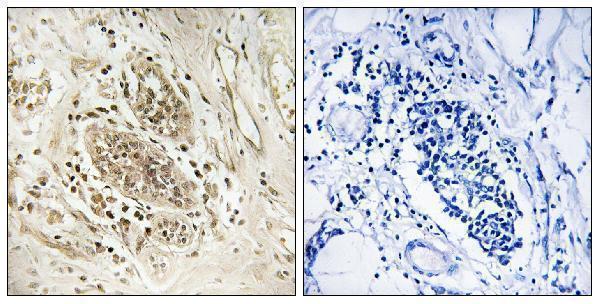 Immunohistochemistry analysis of paraffin-embedded human breast carcinoma tissue, using POLE1 Antibody