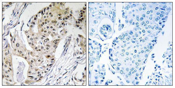 Immunohistochemistry analysis of paraffin-embedded human breast carcinoma tissue, using POLE4 Antibody