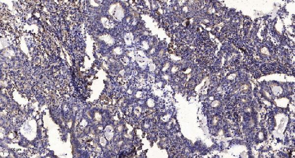 Immunohistochemical analysis of paraffin-embedded human Gastric adenocarcinoma