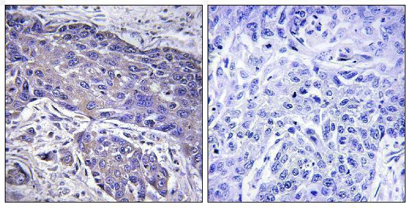 Immunohistochemistry analysis of paraffin-embedded human lung carcinoma tissue, using POFUT1 Antibody