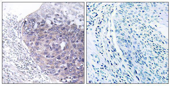 Immunohistochemistry analysis of paraffin-embedded human cervix carcinoma tissue, using GTPBP5 Antibody