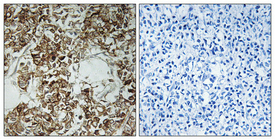 Immunohistochemical analysis of paraffin-embedded Human breast cancer