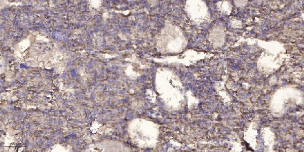 Immunohistochemical analysis of paraffin-embedded human liver cancer