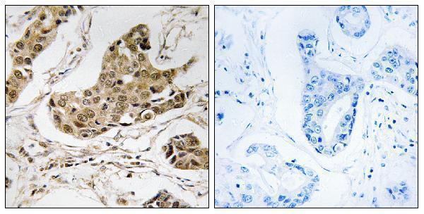 Immunohistochemistry analysis of paraffin-embedded human breast carcinoma tissue, using RTCD1 Antibody