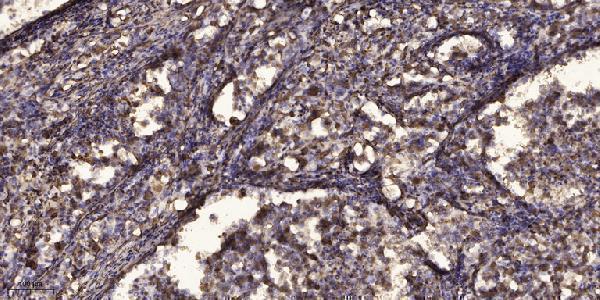 Immunohistochemical analysis of paraffin-embedded human Squamous cell carcinoma of lung