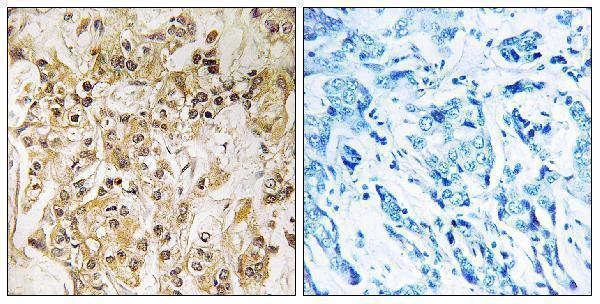 Immunohistochemistry analysis of paraffin-embedded human breast carcinoma tissue, using ZNF295 Antibody