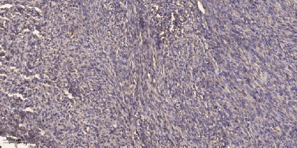 Immunohistochemical analysis of paraffin-embedded human Colon cancer