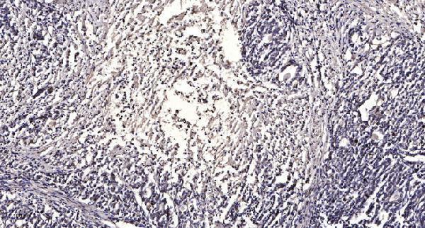 Immunohistochemical analysis of paraffin-embedded human Gastric adenocarcinoma