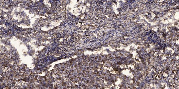 Immunohistochemical analysis of paraffin-embedded human Squamous cell carcinoma of lung