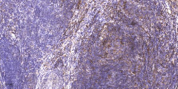 Immunohistochemical analysis of paraffin-embedded human cervical carcinoma