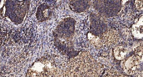 Immunohistochemical analysis of paraffin-embedded human Squamous cell carcinoma of lung