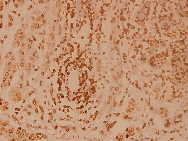 Immunohistochemistry (IHC) analyzes of Elongin A1 (R129) pAb in paraffin-embedded human breast carcinoma tissue at 1:100